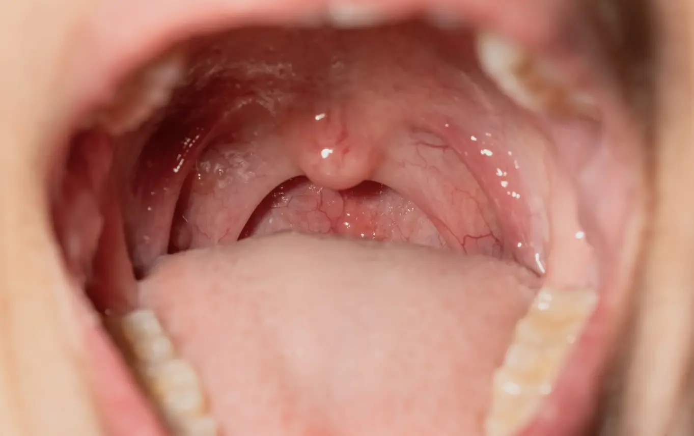 Tonsillitis in adults and children: basics to know