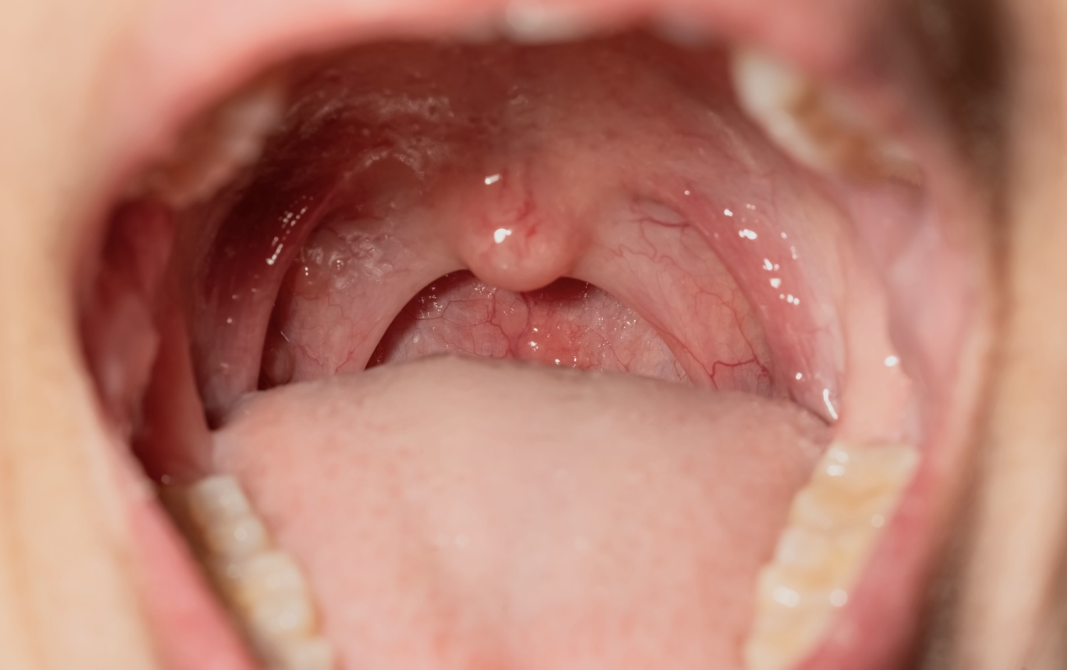 Tonsillitis in adults and children: basics to know